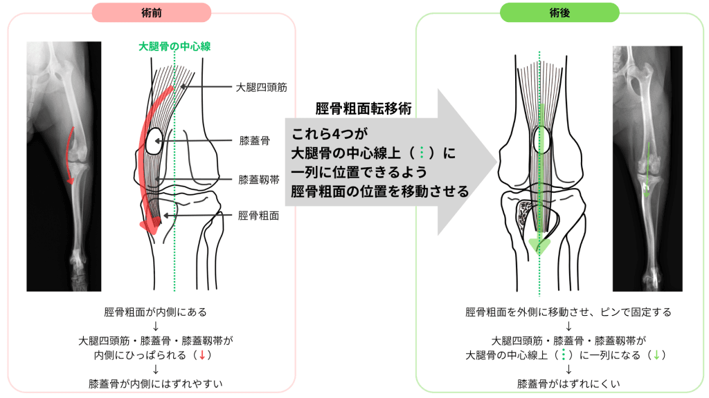 パテラの術式：脛骨粗面転移