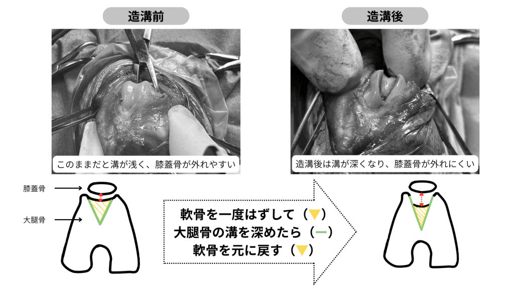 パテラの術式：造溝術