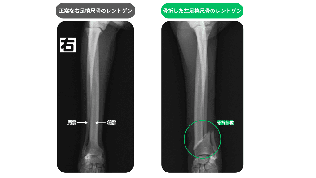 犬の橈尺骨の正常と骨折の比較レントゲン画像